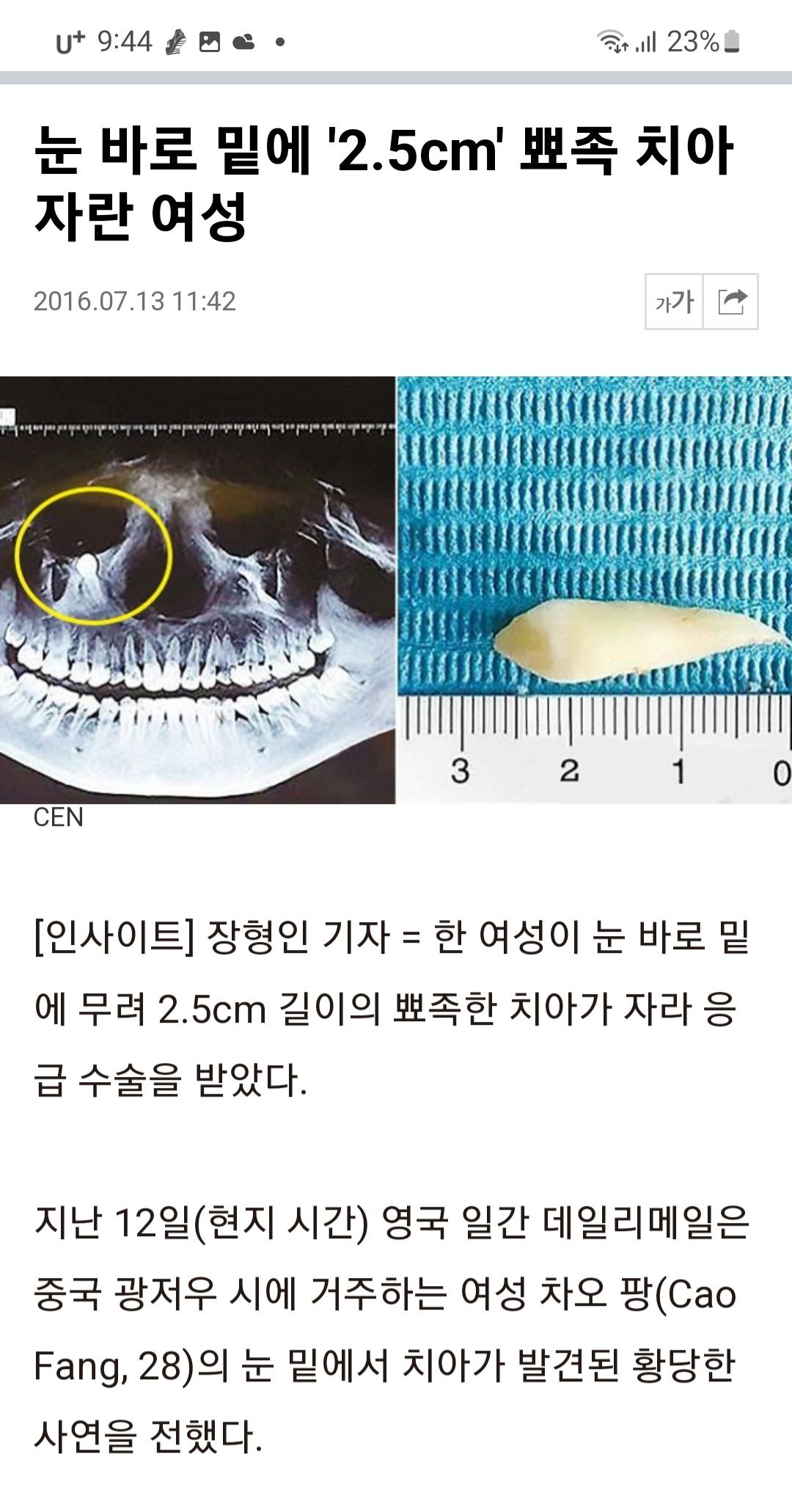 [유머] 3층 사랑니 눈에 과잉치 -  와이드섬